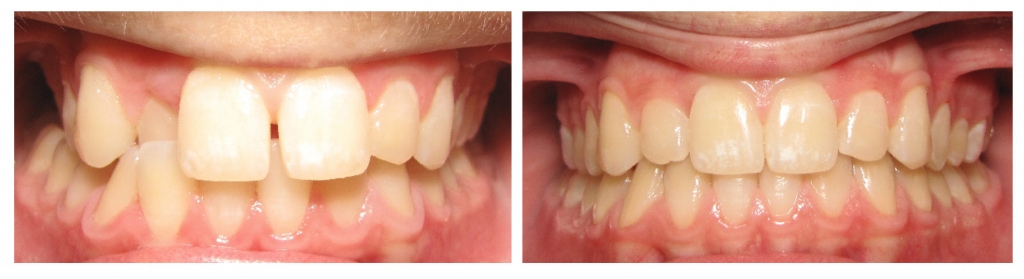 Before and after teeth image