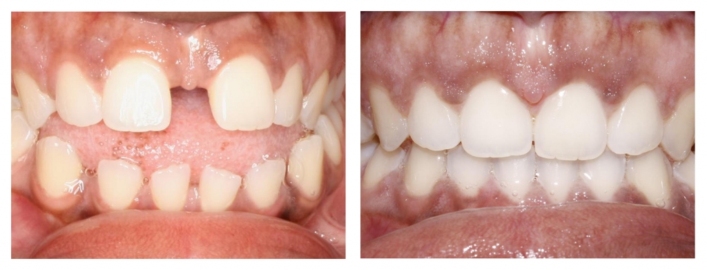 Before and after teeth image